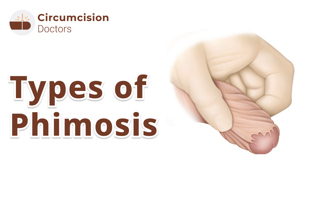 Phimosis: Symptoms, Causes, and Treatment