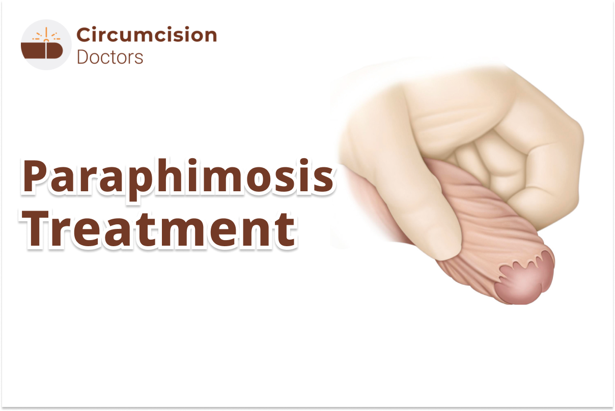 Phimosis Treatment With/Without Surgery in Delhi, India